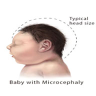 Baby with Microcephaly