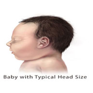 Baby with Typical Head Size