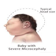 Baby with Severe Microcephaly